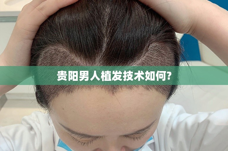 贵阳男人植发技术如何?