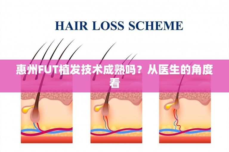 惠州FUT植发技术成熟吗？从医生的角度看