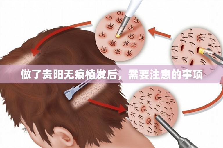 做了贵阳无痕植发后，需要注意的事项