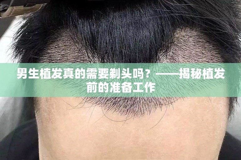 男生植发真的需要剃头吗？——揭秘植发前的准备工作