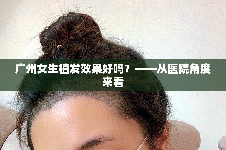 广州女生植发效果好吗？——从医院角度来看