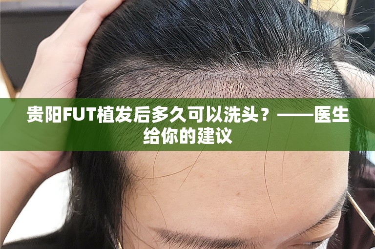 贵阳FUT植发后多久可以洗头？——医生给你的建议