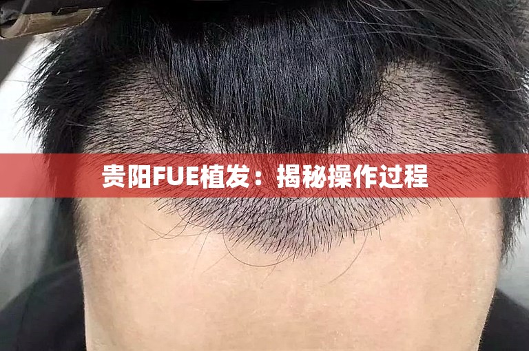 贵阳FUE植发：揭秘操作过程