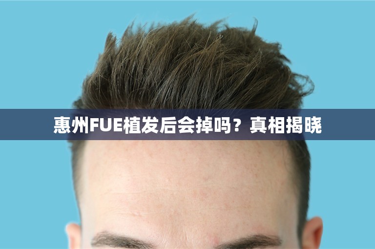 惠州FUE植发后会掉吗？真相揭晓