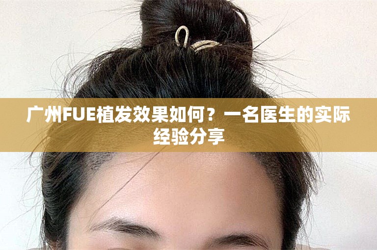 广州FUE植发效果如何？一名医生的实际经验分享