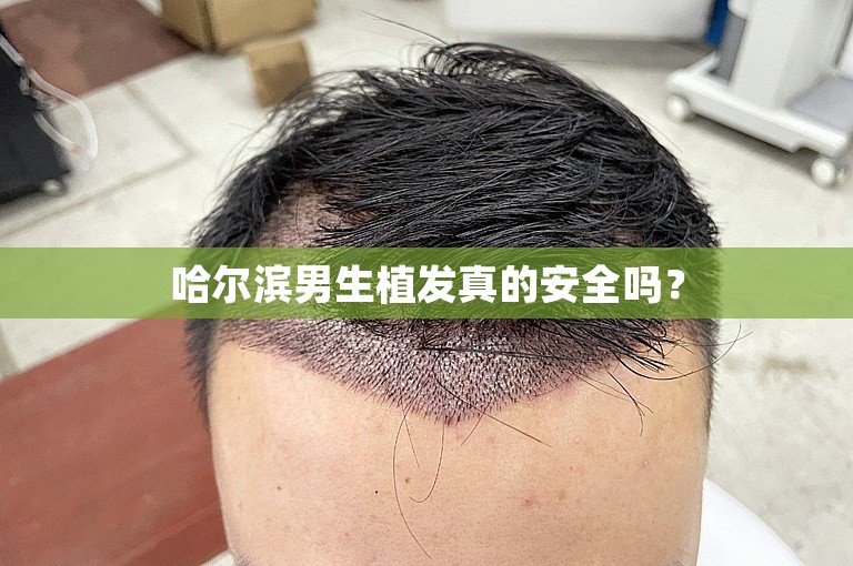 哈尔滨男生植发真的安全吗？