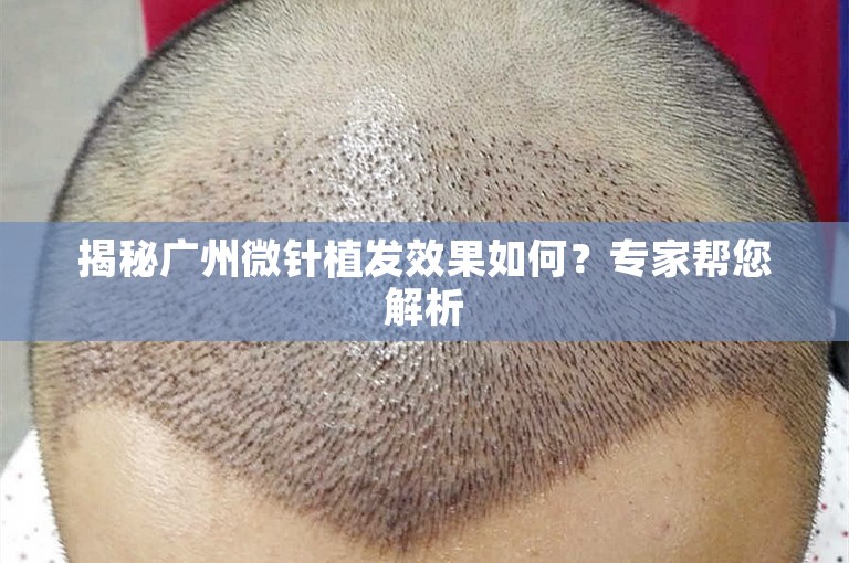 揭秘广州微针植发效果如何？专家帮您解析