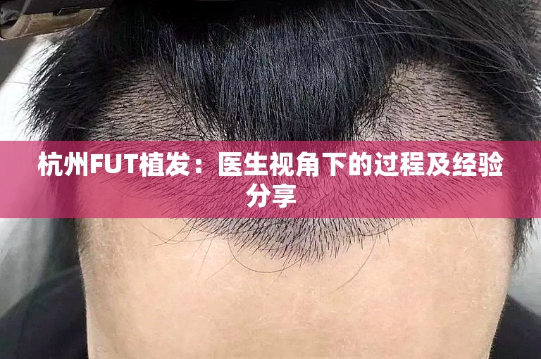 杭州FUT植发：医生视角下的过程及经验分享