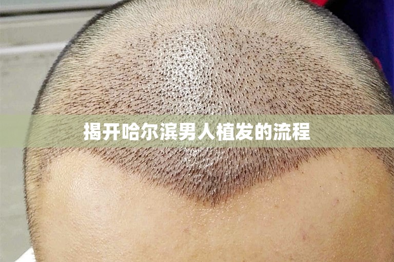 揭开哈尔滨男人植发的流程