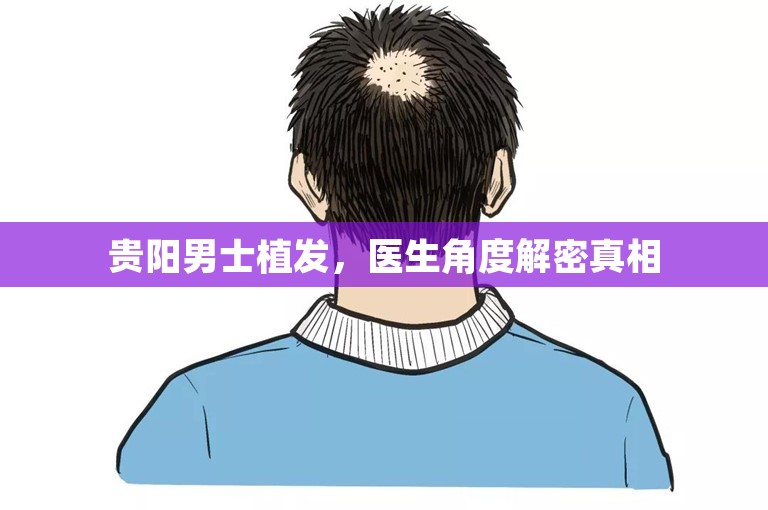 贵阳男士植发，医生角度解密真相