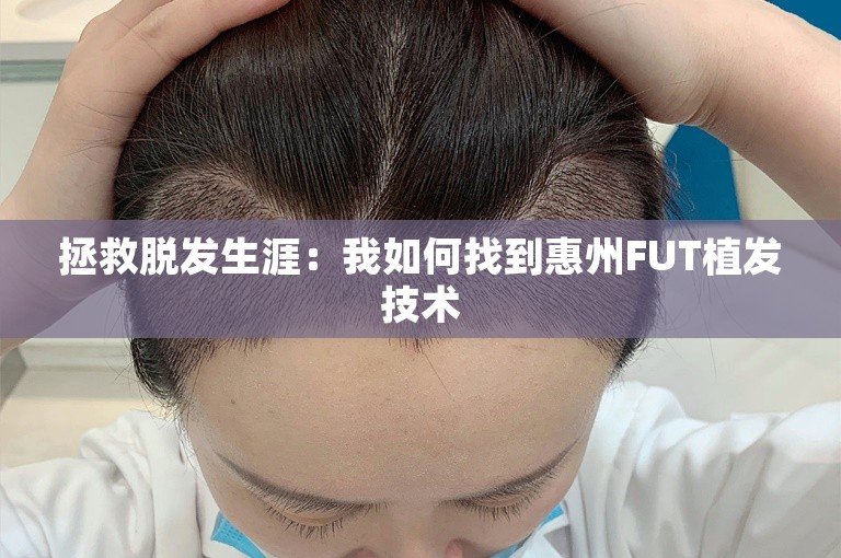 拯救脱发生涯：我如何找到惠州FUT植发技术