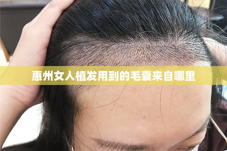 惠州女人植发用到的毛囊来自哪里