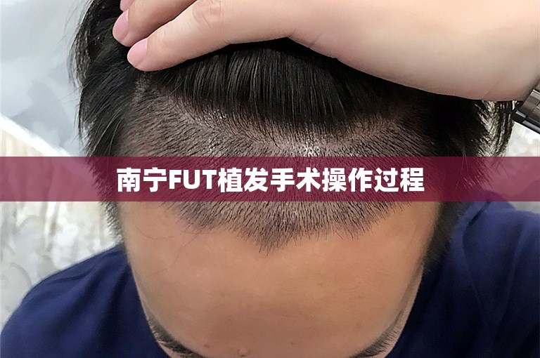 南宁FUT植发手术操作过程