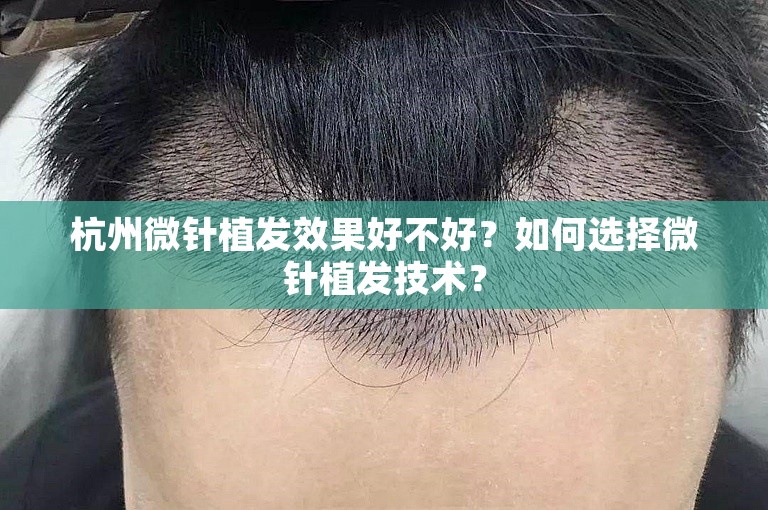 杭州微针植发效果好不好？如何选择微针植发技术？