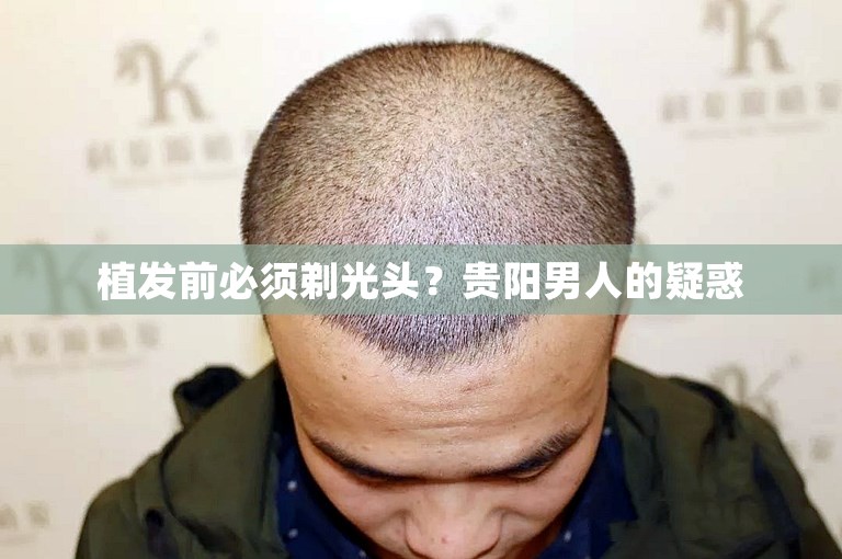 植发前必须剃光头？贵阳男人的疑惑