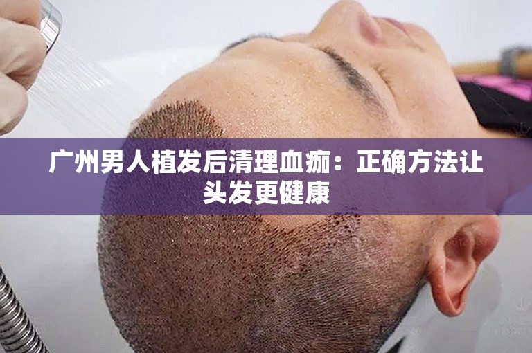 广州男人植发后清理血痂：正确方法让头发更健康