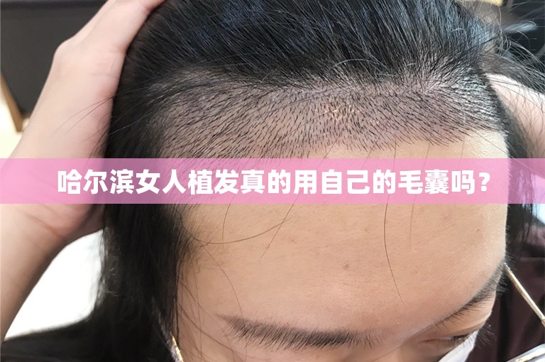 哈尔滨女人植发真的用自己的毛囊吗？