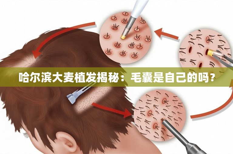 哈尔滨大麦植发揭秘：毛囊是自己的吗？