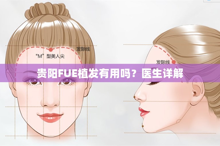 贵阳FUE植发有用吗？医生详解