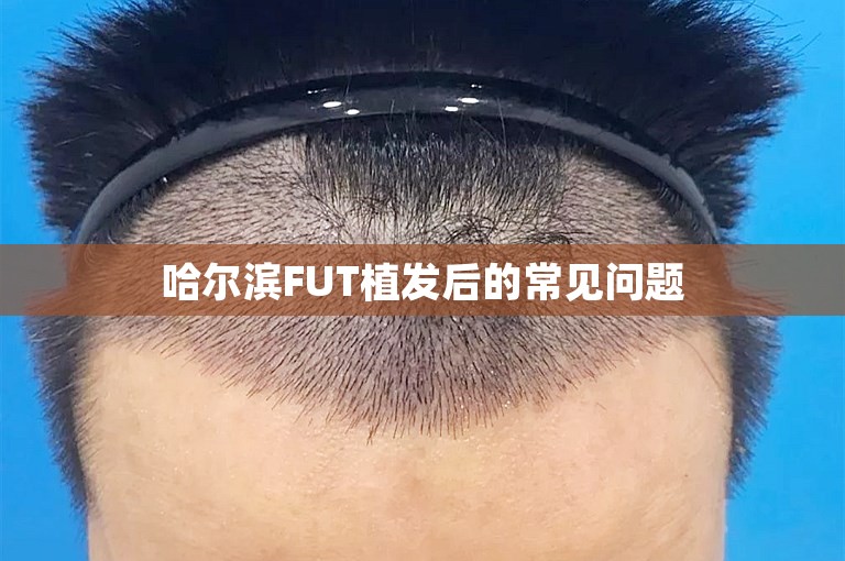 哈尔滨FUT植发后的常见问题