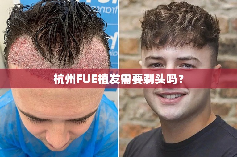 杭州FUE植发需要剃头吗？