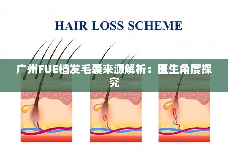 广州FUE植发毛囊来源解析：医生角度探究