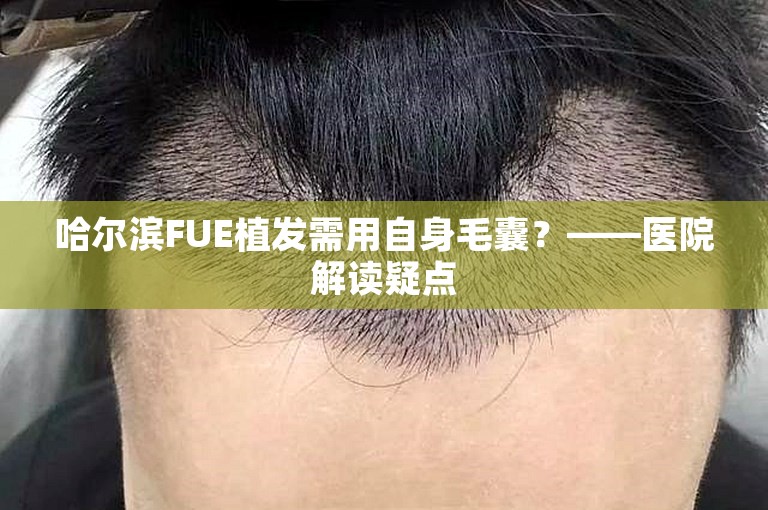 哈尔滨FUE植发需用自身毛囊？——医院解读疑点