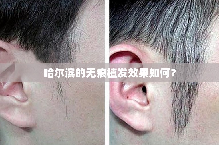 哈尔滨的无痕植发效果如何？