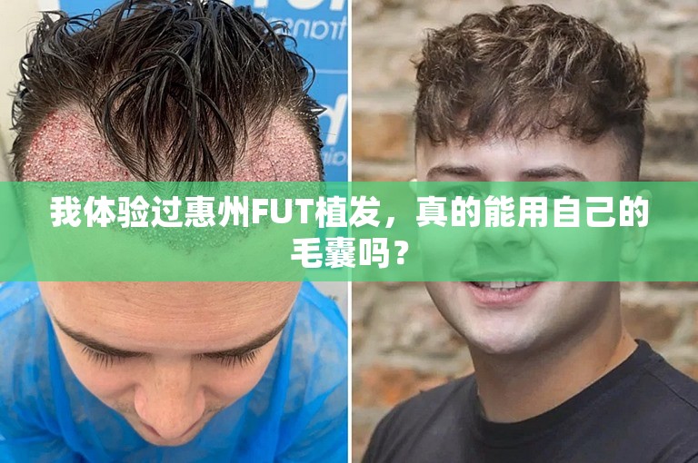 我体验过惠州FUT植发，真的能用自己的毛囊吗？