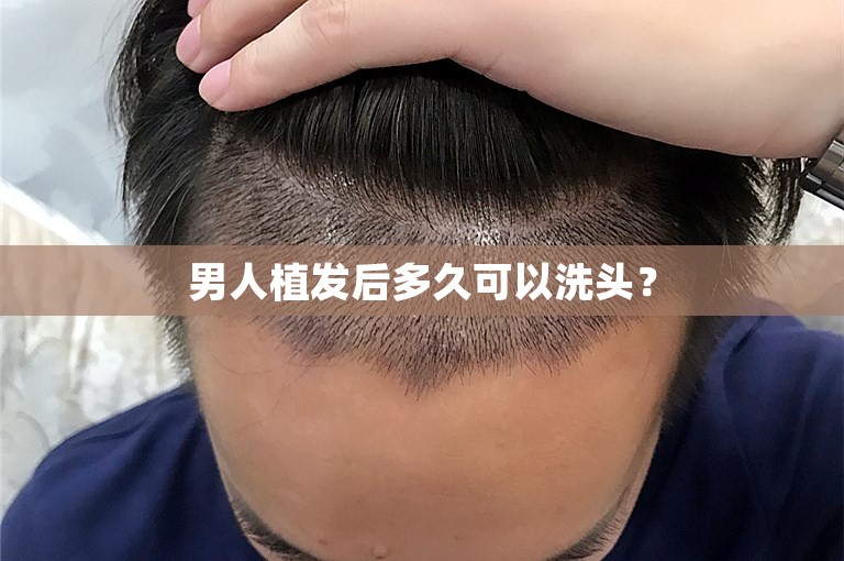 男人植发后多久可以洗头？