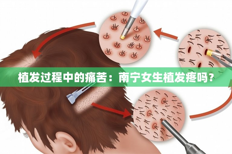 植发过程中的痛苦：南宁女生植发疼吗？