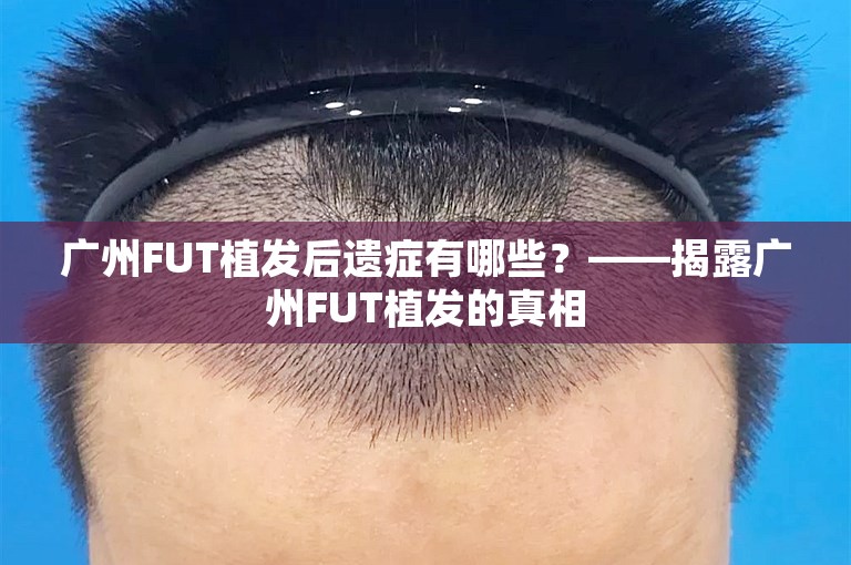 广州FUT植发后遗症有哪些？——揭露广州FUT植发的真相