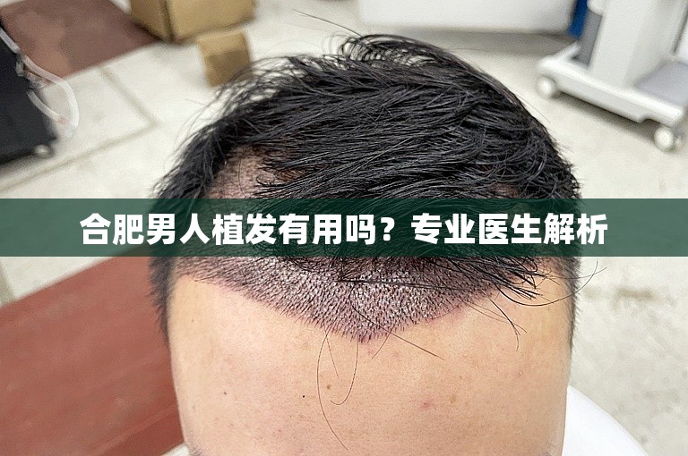 合肥男人植发有用吗？专业医生解析