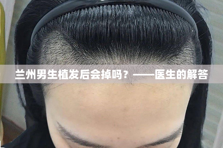 兰州男生植发后会掉吗？——医生的解答