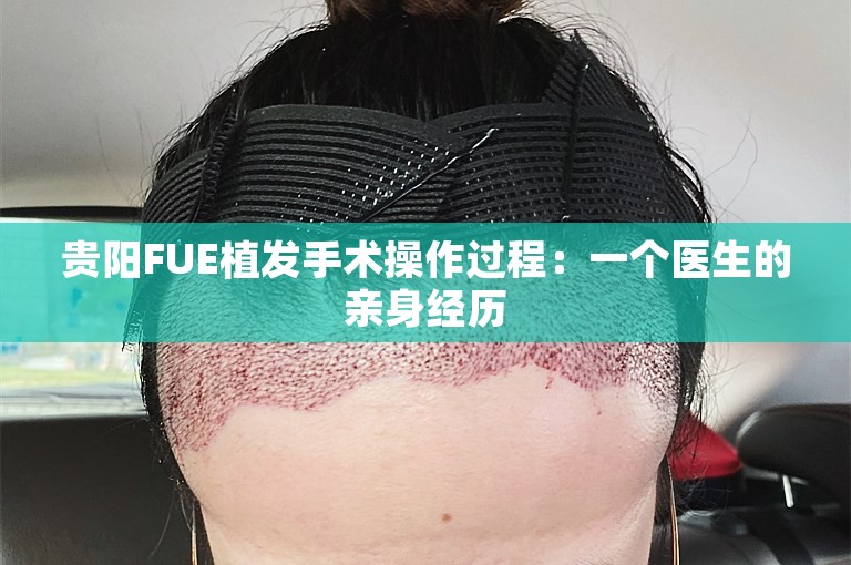 贵阳FUE植发手术操作过程：一个医生的亲身经历