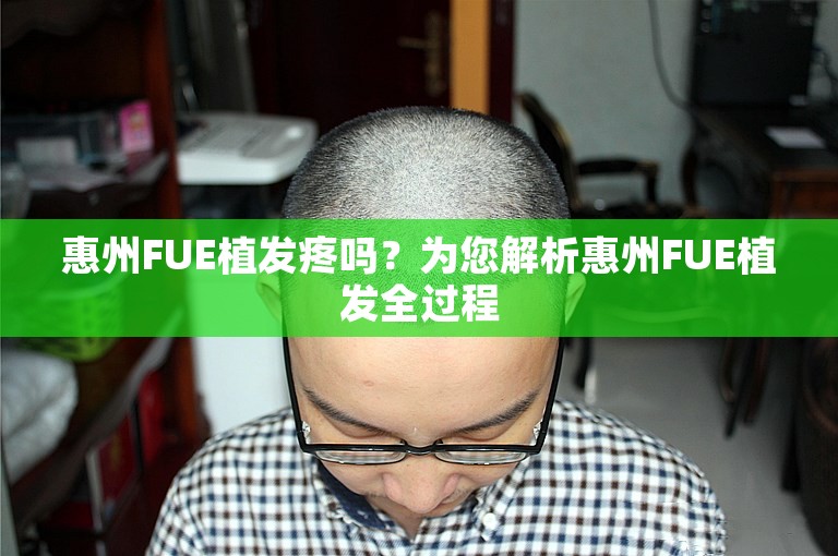 惠州FUE植发疼吗？为您解析惠州FUE植发全过程