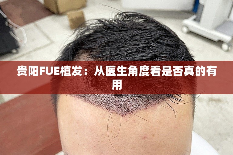 贵阳FUE植发：从医生角度看是否真的有用