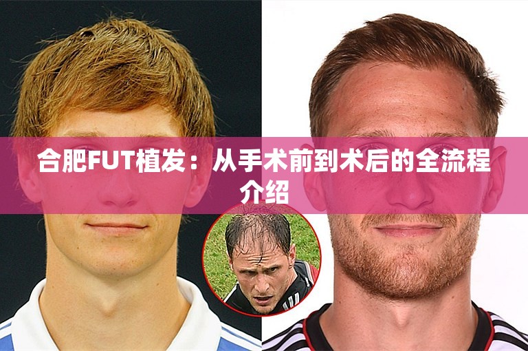 合肥FUT植发：从手术前到术后的全流程介绍