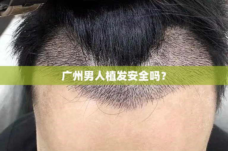 广州男人植发安全吗？