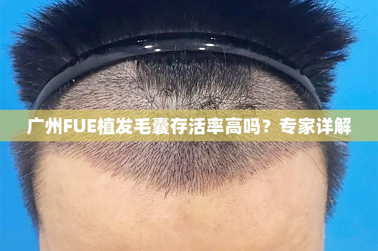 广州FUE植发毛囊存活率高吗？专家详解