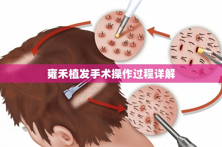 雍禾植发手术操作过程详解