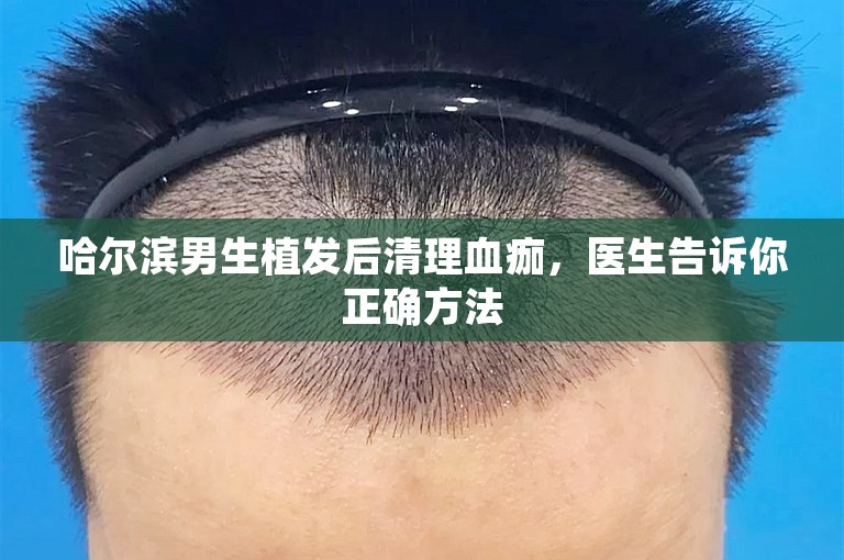 哈尔滨男生植发后清理血痂，医生告诉你正确方法