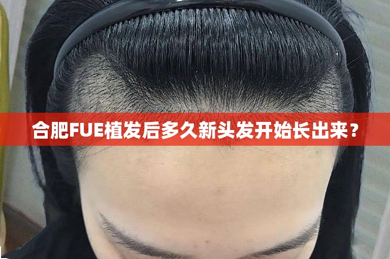 合肥FUE植发后多久新头发开始长出来？