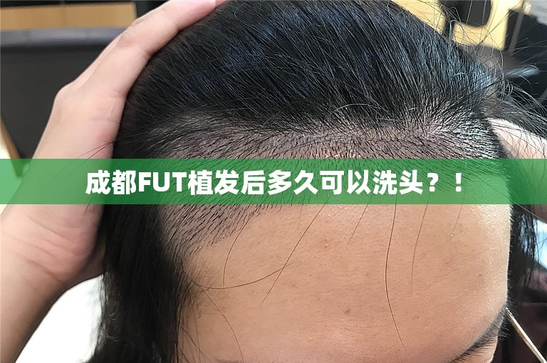 成都FUT植发后多久可以洗头？！