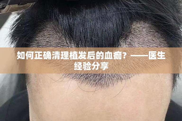 如何正确清理植发后的血痂？——医生经验分享