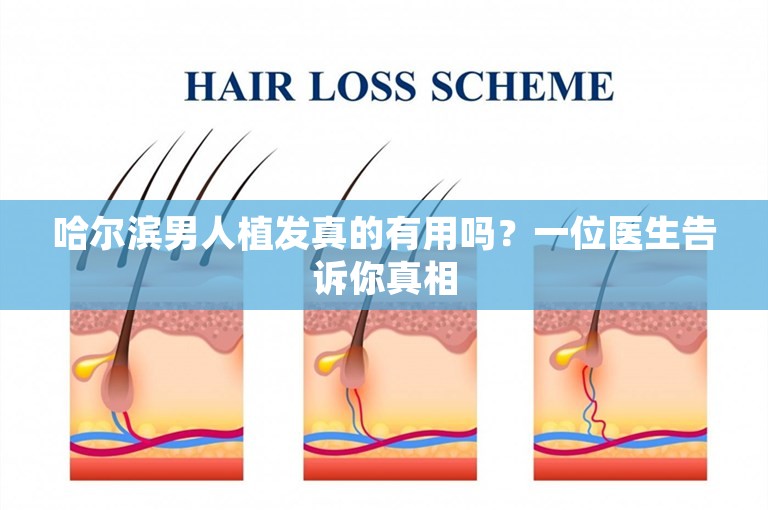 哈尔滨男人植发真的有用吗？一位医生告诉你真相