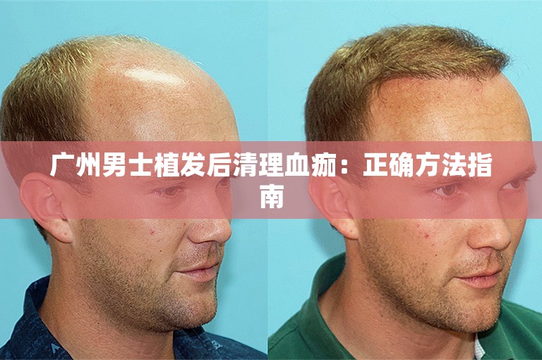 广州男士植发后清理血痂：正确方法指南