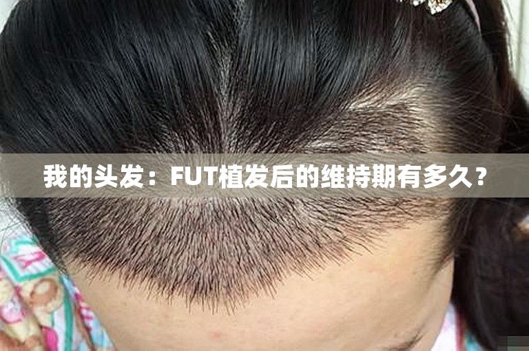 我的头发：FUT植发后的维持期有多久？