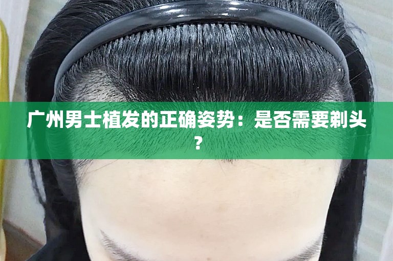 广州男士植发的正确姿势：是否需要剃头？