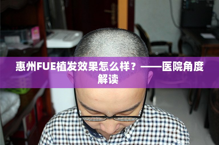 惠州FUE植发效果怎么样？——医院角度解读 